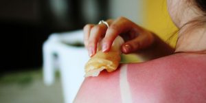 How to treat sunburn this summer and avoid it for the future