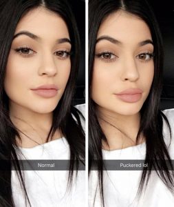 Lip Injections? Here are some things you should know before the needle