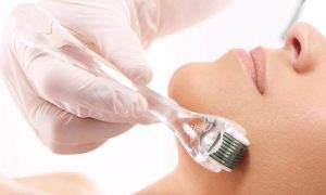 Everything You Should Know About Microneedling